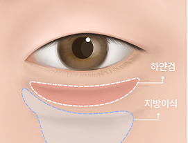 눈 밑 아래쪽의 앞 볼이 꺼져있는 경우